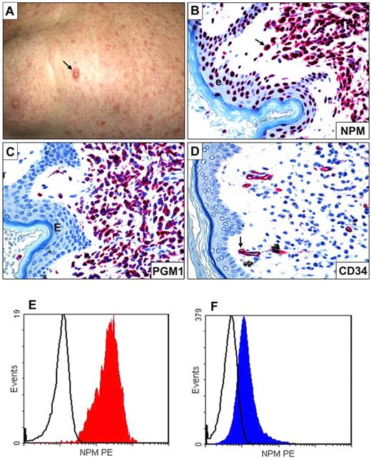 Figure 4. Myeloid sarcoma expressing cytoplasmic NPM1 and flow cytometric detection of cytoplasmic nucleophosmin in AML. (A) Multiple skin lesions; the arrow indicates the largest lesion. (B) Leukemic cells infiltrating the derma show aberrant cytoplasmic expression of NPM (arrow); the cells of epidermis (e) exhibit the expected nucleus-restricted positivity for NPM. (C) Leukemic cells express the histiocyte-restricted form of CD68 (monoclonal antibody PG-M1). (D) Leukemic cells are CD34−; the arrow indicates a CD34+ vessel that serves as internal control. (B-D) Alkaline phosphatase antialkaline phosphatase technique; hematoxylin counterstaining; images were collected using an Olympus B61 microscope and a UPlan FI 100×/1.3 NA oil objective; Camedia 4040, Dp_soft Version 3.2; and Adobe Photoshop 7.0. (E) Flow cytometry analysis of cytoplasmic nucleophosmin in AML. NPM1-mutated AML M5b 48% blasts showing the phenotype: CD34−CD13+CD33+CD117+MPO− CD56+NPMc+. (F) AML M1 with wild-type NPM1 gene and 93% blasts with phenotype: CD34+ CD13+ CD33+ CD117+ MPO+CD56+NPMc− (bottom left and right; courtesy of Prof Christian Thiede and Dr U. Oelschlaegel, University of Dresden, Dresden, Germany).