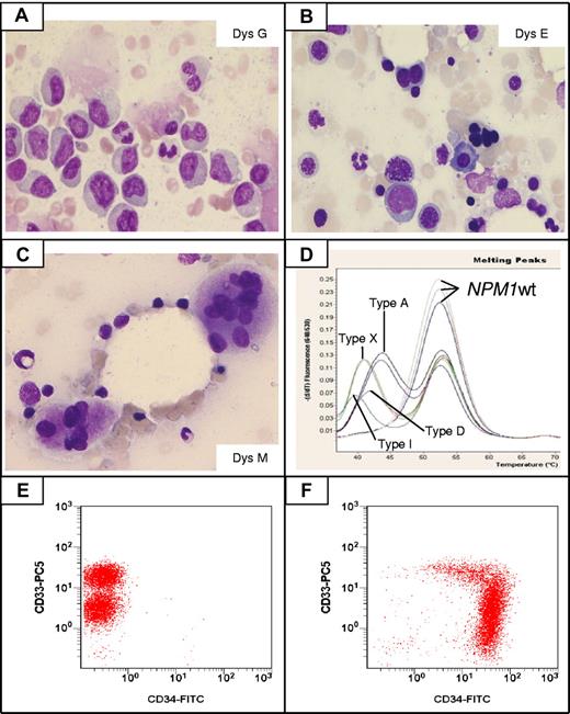 Figure 5. Multilineage dysplasia in NPM1-mutated AML. (A) Dysgranulopoiesis (Dys G) in a case of NPM1-mutated AML showing myeloid cells with hypogranulated cytoplasm and pseudo-Pelger cells. Bone marrow, Pappenheim staining. (B) Dyserythropoiesis (Dys E) in a case of NPM1-mutated AML showing nuclear irregularity with fragmentation, a mitosis, and multinucleation of red precursors. Bone marrow, Pappenheim staining. (C) Dysmegakaryopoiesis (Dys M) in a case of NPM1-mutated AML showing 2 dysplastic megakaryocytes with multiple nuclei. Bone marrow, Pappenheim staining. (A-C) All images were collected using a Zeiss Axio Imager.A1, 63×/1.4 oil objective Plan-Apochromat; 10×/23 eyepiece Sony camera 3CCD HD, Model MC-HD 1/3 Horn imaging DHS solution. (D) Lightcycler-based melting curve analyses showing different NPM1 mutation types in AML with MLD changes: A (nt959insTCTG), D (nt959insCCTG), I (nt959insCTTG), X (nt959insTTCC), and wild-type patients. (E-F) Expression of CD34 by multiparameter flow cytometry. A case with NPM1 mutation and MLD changes demonstrating a lack of expression of CD34 (E, note the different levels of CD33 expression between myeloblasts and monoblasts). A different AML MLD+ case without NPM1 mutation showing a strong expression of CD34 with a part of the population lacking CD33 expression (F). Slightly modified from Falini et al88 with permission.