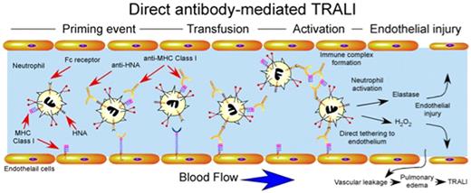 Figure 3. Direct antibody-mediated TRALI. Priming events may or may not be required for antibody-induced TRALI, but appear to significantly exacerbate TRALI when present. Transfusion of blood products containing antibodies against HNA and MHC class I can result in direct activation of intravascular neutrophils. Anti-MHC class I antibodies recognizing endothelial MHC class I may also directly tether neutrophils to the endothelium independent of selectin or integrin-mediated events. Immune complexes of anti-HNA or anti-MHC class I and soluble HNA or MHC class I may also be recognized by Fc receptors resulting in neutrophil activation. Intravascular activation of neutrophils results in damage to endothelial cells, vascular leakage and pulmonary edema.