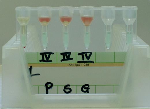 An 84-year-old man with Waldenström macroglobulinemia was seen for routine check-up. Laboratory evaluation revealed hemoglobin 72.0 g/L, white blood cell count 1.5 × 109/L, and platelet count 113 × 109/L. A blood sample was sent to the transfusion center for type and screen. / In antibody screening that utilizes the gel column technique, test erythrocytes and patient's serum usually form a mixture immediately after automated sampling as shown with sample G (a healthy individual). However, test erythrocytes mixed neither with the patient's plasma (sample P) nor with his serum (sample S). Instead, a distinct cellular layer rested on the patient's probes after sampling. This finding raised the suspicion of an increased serum and plasma viscosity that prevented the spreading of test erythrocytes. / This laboratory test led to a diagnosis of hyperviscosity that was confirmed fundoscopically and with the finding of an immunoglobulin M level of 101 g/L. After the patient was treated with plasmapheresis, subsequent plasma and serum samples that were tested for antibody screening no longer showed this abnormality. / Usually clinical features of hyperviscosity initiate the diagnosis. In this case, an unusual finding in antibody screening was subsequently affirmed clinically as hyperviscosity.