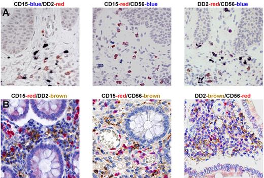 Figure 7. NK cells, slanDCs, and neutrophils colocalize in lesions of patients with psoriasis and Crohn disease. Immunohistochemistry was performed using sections from biopsies of skin from psoriasis patients (A) and intestine from Crohn disease patients (B). Double-staining analysis revealed that both DD2+ slanDCs and CD56+ NK cells were present in tissue samples of the 3 examined diseases and colocalized with CD15+ neutrophils. One representative experiment for each pathology (n = 5) is shown.
