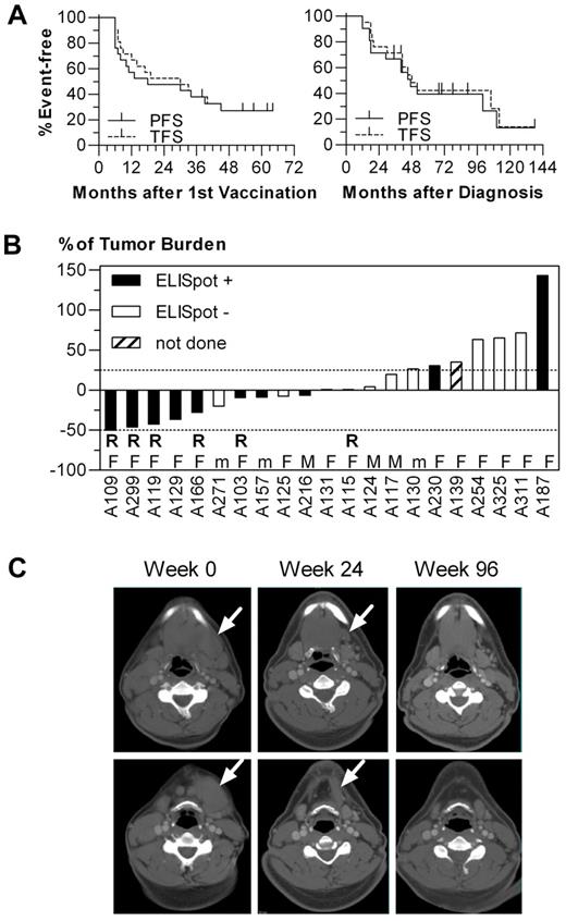 Figure 5. Clinical outcome in upfront vaccination (group A). (A) Kaplan-Meier curves of progression-free survival (PFS) and treatment-free survival (TFS) after vaccination start (left panel) and lymphoma diagnosis (right panel). (B) Evolution of total lymphoma burden at 24 weeks after the first vaccination in relationship to cellular immune responses and lymphoma entity. R indicates patients who eventually achieved an objective partial remission; F, follicular lymphoma; M, mantle cell lymphoma; and m, marginal zone lymphoma. (C) Computed tomography scans of patient A119 with a near-complete disappearance of a disfiguring submandibular lymphoma manifestation.