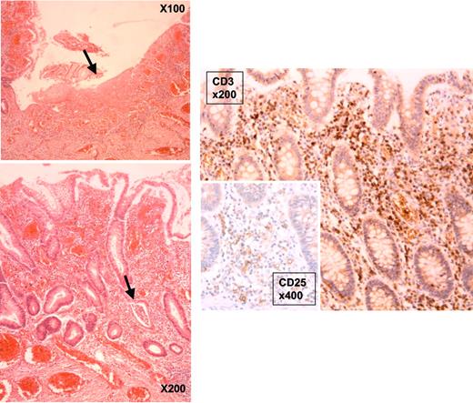 Figure 2. Histology of the large bowel of PX1.7 with XIAP deficiency. (Top left) On hematoxylin and eosin at low magnification (×100), a large ulceration is seen, indicated by an arrow. (Bottom left) Higher magnification (×200) shows a massive polymorphic inflammatory infiltrate associated with a crypt abscess (indicated by the arrow). (Central right) Immunostaining with anti-CD3 shows frequent lymphoid T cells (on the right, ×200), some of them express the activation marker CD25 (×400, inset).