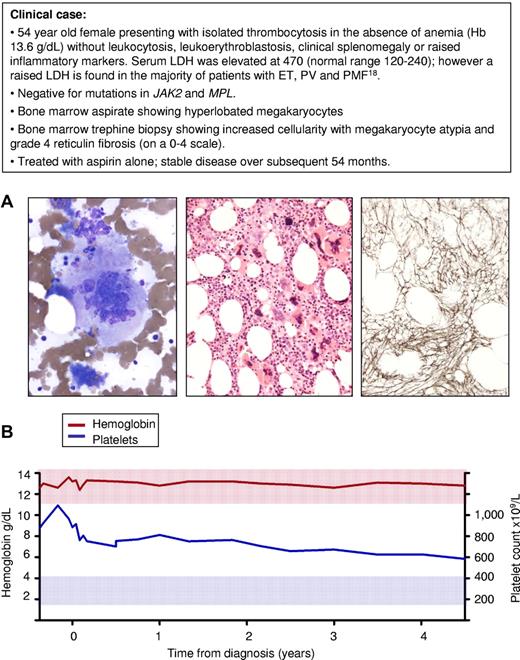 Figure 2. Isolated thrombocytosis and bone marrow fibrosis in the absence of clinical features to support a diagnosis of primary myelofibrosis. (A) Bone marrow samples obtained at diagnosis from a 54-year-old female patient with thrombocytosis in the absence of additional features of PMF: left, bone marrow aspirate stained with Wright-Giemsa showing a large megakryocyte with a hyperlobated nucleus; middle, bone marrow trephine biopsy stained with hematoxylin and eosin showing loose clusters of megakaryocytes containing both large megakaryoctes with hyperlobated nuclei and smaller forms with cloud-like or hyperchromatic nuclei; right, silver-stained bone marrow section showing grade 4 reticulin fibrosis (on 0-4 scale). (B) Blood counts during the course of 54 months from diagnosis showing stabilization of the platelet count and no change in hemoglobin level. Red and blue shaded areas represent the normal range for hemoglobin and platelet count, respectively.