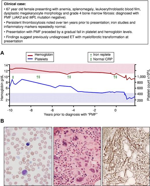 Figure 3. Presentation with myelofibrotic transformation of previously undiagnosed ET. (A) Platelet and hemoglobin levels during a 10-year period before presentation with PMF in a patient at the age of 67 years; a marked thrombocytosis between 8 and 10 years before diagnosis is followed by a gradual decrease in platelet count and progressive anemia in the absence of iron deficiency or inflammation. (B) At clinical presentation, left, Wright-Geimsa–stained blood film showing leukoerythroblastosis and tear-drop red cells; middle, hematoxylin and eosin–stained bone marrow trephine biopsy showing clusters of dysplastic megakaryocytes; and right, silver-stained bone marrow trephine biopsy showing grade 4 reticulin fibrosis (on 0-4 scale). Red and blue shaded areas represent the normal range for hemoglobin and platelet count, respectively.