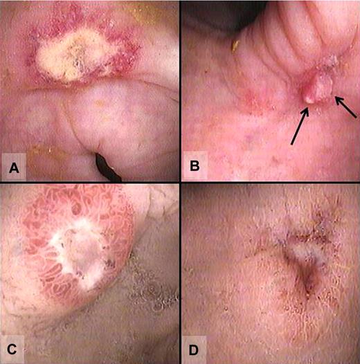 Figure 1. Endoscopic images of NK-cell enteropathy. (A-B) Colonic lesions. The colonic lesions generally appeared as ulcers with surrounding erythema and edema (A), but some lesions had a more nodular or polypoid appearance (B). (C-D) Gastric and duodenal lesions. The main lesions noted were raised ulcer-like lesions surrounded by erythema and edema (duodenal lesion; C); a few small punctuate deep ulcers in the stomach (D) were also noted and had similar pathologic appearance as the other NK-cell lesions throughout the gastrointestinal tract. Images were processed with Adobe Photoshop.