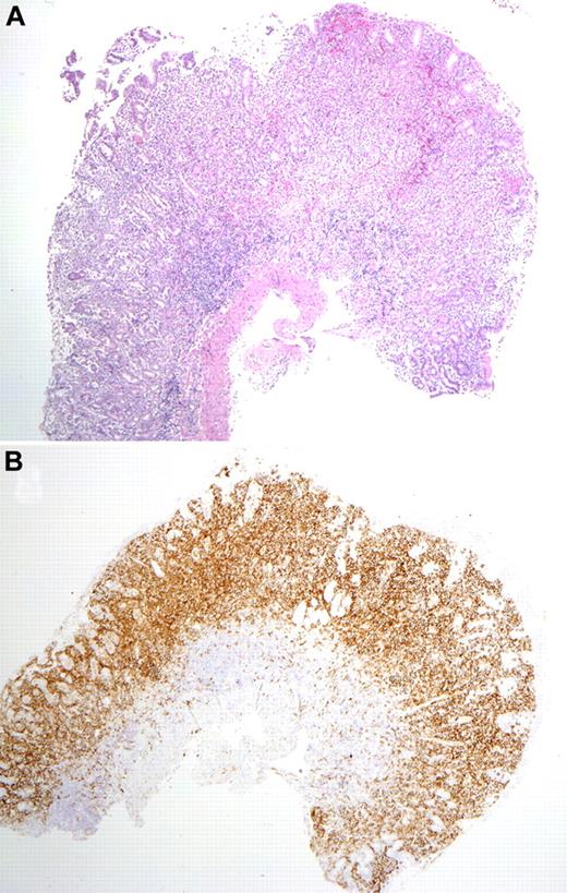 Figure 2. Mucosal biopsy findings. (A) Biopsy of the gastric antrum shows diffuse infiltration of the lamina propria by the atypical cells. The muscularis mucosa is intact, without infiltration of the submucosa. (B) A CD56 stain of the same biopsy highlights the atypical infiltrate. Photomicrographic images were acquired with a Nikon Eclipse 50i microscope equipped with an Olympus DP71 camera and software. Final image preparation was performed with Adobe Photoshop CS3 extended Version 10.0.1. Magnification: 2×/0.1 NA Plan Apo lens.