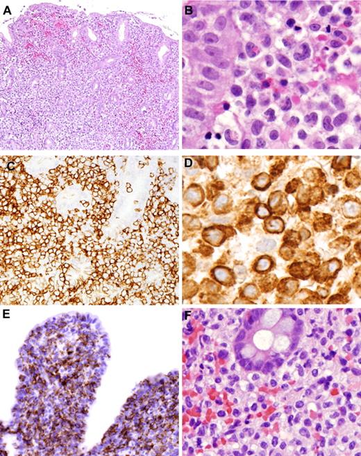 Figure 3. Histologic and immunohistochemical features of NK-cell enteropathy. Representative cases are shown involving stomach (A-D), duodenum (E), and colon (F). (A) The atypical cells infiltrate the mucosa, separating and displacing the glands. (B) Epitheliotropism is largely absent, but the cells show cytologic atypia, with irregular nuclei and eosinophilic, granular cytoplasm. (C) NK cells are strongly positive for CD56 and diffusely infiltrate the mucosa, with rare cells infiltrating the glandular epithelium. The infiltrate does not extend to the submucosa. (D) The cells express cytoplasmic CD3 (D), and immunohistochemical stains highlight the cytologic atypia. (E) CD56 identifies atypical NK cells diffusely infiltrating and expanding duodenal villi. (F) Atypical cells surround colonic glands with focal areas of superficial hemorrhage. (C-E) Immunohistochemistry with avidin-biotin-peroxidase complex immunoperoxidase technique and hematoxylin counterstain. Photomicrographic images were acquired with a Nikon Eclipse 50i microscope equipped with an Olympus DP71 camera and software. Final image preparation was performed with Adobe Photoshop CS3 extended Version 10.0.1. Original magnifications: panel A, 4×/0.2 NA; panel B, 40×/0.95 NA; panel C, 10×/0.45 NA; panel D, 100×/1.40 NA; panel E, 10×/0.45 NA; panel F, 20×/0.75 NA.