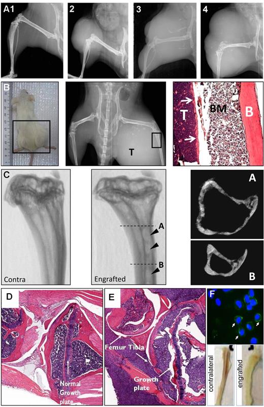 Figure 2. Major characteristics of the INA6 model of MBD. (A) X-ray imaging of the various arbitrary stages (stage 1-4) of plasmacytoma formation. (B) Gross (left), x-ray (center), and histologic (right) appearance of a high grade plasmacytoma and associated bone destruction. The histology shows the fibula with the tumor (T), bone marrow (BM), and cortical bone (B) labeled. (C) The 3-dimensional μCT renderings of contralateral (unaffected left) and engrafted (affected middle) proximal tibias showing focal OLs penetrating deep into the cortices (arrowheads). Axial reconstructions at levels A and B of the affected tibia are presented (right panels) demonstrating the depth of the lesions. (D-E) Histologic analysis of contralateral (D) and engrafted (E) knee joints demonstrating infiltration and disruption of the growth plate architecture. (F) Staining of bone marrow preparations from engrafted long bones with human-specific anti–CD138 antibody (top), demonstrating frequent CD138+ cells. Nuclei are counterstained with 4′,6-diamidino-2-phenylindole. Slides were examined using a Nikon Eclipse 800 upright microscope fitted with a Nikon DXM1200F digital camera. (F) Gross appearance of engrafted and contralateral tibias (bottom), demonstrating displacement of hematopoiesis. Representative images of n = 10 mice per group; experiment was performed twice.