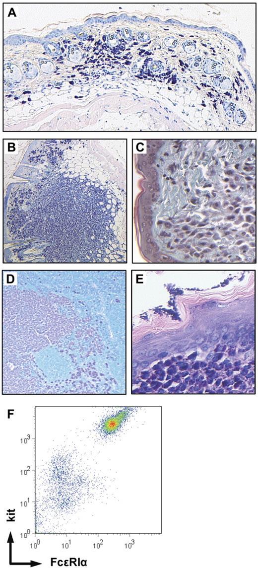 Figure 3. Mastocytosis in kitD814Vflox Mx1-Cre animals. Giemsa-stained skin sections (mast cells dark purple, 5×/0.15 NA objective) revealed increased numbers of mast cells (A) in all mice and the presence of multiple mast cell skin tumors (B, 5×/0.15 NA objective) in 24 of 39 animals. (C) The mast cell tumors destroyed the dermal collagen as demonstrated by trichrome-Masson staining (green represents collagenous fibers; and pink, mast cells, 20×/0.7 NA objective). (D) Mast cells infiltrating a skin draining lymph node (Giemsa staining: dark purple represents mast cells; and turquoise, nonmast cell hematopoietic cells, 5×/0.15 NA objective) and (E) mast cell infiltrate in the submucosa of the forestomach (Giemsa, 20×/0.7 NA objective). (F) Flow cytometric analysis of a dermal mast cell tumor. A single-cell suspension prepared from a skin mast cell tumor was stained for kit and the high-affinity IgE receptor-α chain (FcϵRIα) and analyzed by flow cytometry.