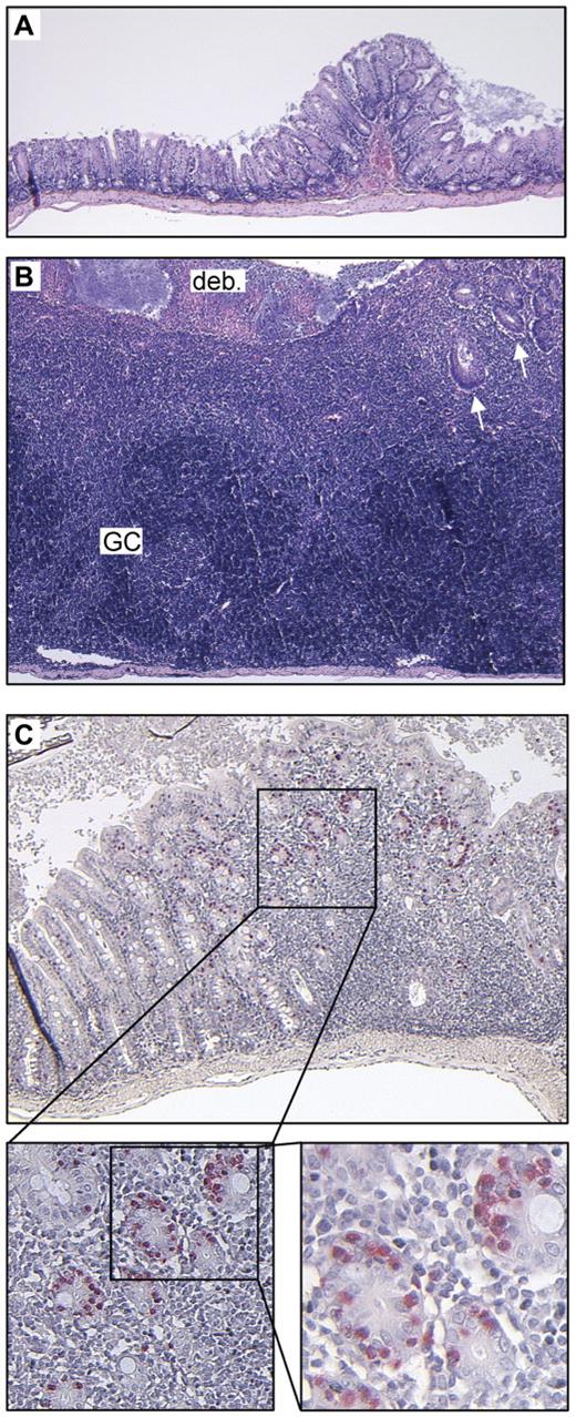 Figure 5. Intestinal inflammation in kitD814Vflox Mx1- Cre animals. Constitutive kit activation causes intestinal inflammation. Unaffected (A) and inflamed (B) colonic wall of the identical kitD814Vflox Mx1-Cre animal at the same magnification (hematoxylin and eosin staining, 5×/0.15 NA objective). Note the massive inflammatory infiltrate with almost complete destruction of epithelial structures and erosion of the luminal surface epithelium covered with fibrin and cellular debris (deb.). Some residual crypts can be found in the upper right quadrant (arrows). The inflammatory process has also partly destroyed the lamina muscularis propria (reduced thickness compared with the unaffected colonic wall). The inflammatory infiltrate contains (dark blue) areas densely populated by B and T lymphocytes (as demonstrated by immunostaining; supplemental Figure 2), which also form germinal centers (GC). (C) Mildly inflamed colonic wall of a kitD814Vflox Mx1-Cre mouse stained for chloroacetate esterase. Note the accumulation of high numbers of intraepithelial mucosal mast cells (stained red, 5×/0.15 NA, 10×/0.4, 20×/0.7 NA objectives, respectively) within the crypt epithelium surrounding the inflammatory lesion. The inflammatory infiltrate itself contains only few mast cells.