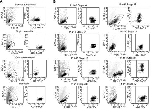 Figure 1. CTCL skin lesions contain a high-scatter population of T cells not seen in normal skin or lesional skin from 3 other T cell–mediated inflammatory skin disorders. (A) T cells were isolated from normal human skin (12 patients) or lesional skin from patients with atopic dermatitis (6 patients), contact dermatitis (1 patient), or psoriasis (6 patients) with the use of short-term explant cultures. All samples tested contained a single population of CD3+ T cells. (B) T cells were then isolated from CTCL skin lesions with the use of short-term explant cultures. Patients with all stages of CTCL exhibited 2 clear populations of T cells. The lower-scatter population had a forward scatter (reflecting size) and a side scatter (reflecting complexity) similar to that of T cells from normal skin, whereas the high-scatter population consisted of larger and more complex cells. Eight representative patients are shown, similar results were obtained in 30 additional patients. SSC-A indicates side-scatter area; FSC-H, forward-scatter height; PerCP, peridin chlorophyll protein; APC, allophycocyanin.