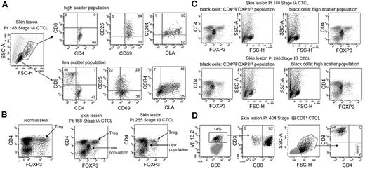 Figure 2. High-scatter T cells from CTCL lesional skin are highly activated CD4+ skin homing T cells with elevated FOXP3 expression. (A) Comparison of the phenotype of high- and low-scatter T cells isolated from MF lesional skin. THS cells were uniformly CD4+ and expressed high levels of the activation markers CD69 and CD25 and the skin-homing addressins CCR4 and CLA. In contrast, low-scatter T cells contained a mixed CD4 and CD8 T cells with variable expression of activation markers and skin-homing addressins. Similar results were observed in 6 additional patients with stage I-III CTCL. (B) MF lesional skin contains a unique population of T cells with intermediate CD4 and FOXP3 expression. MF skin lesions contained both FOXP3high regulatory T cells (Tregs), also found in normal skin, and a novel population of T cells expressing intermediate levels of both CD4 and FOXP3. (C) Selective gating on this novel population of T cells (CD4intFOXP3int) showed that it corresponded closely to the THS cell population. Reversing the gating confirmed that the high-scatter T-cell population was comprised entirely of these CD4intFOXP3int T cells. A second patient with stage IB disease is also shown. Similar findings were observed in 4 additional patients. (D) In a patient with CD8+ MF diagnosed by histopathologic studies, a clonal population of CD8+ T cells expressing TCR Vβ 13.2 existed in lesional skin. THS cells in this patient were CD8+. SSC-A indicates side-scatter area; FSC-H, forward-scatter height. In gated histograms, the % total cells in each quadrant are shown.