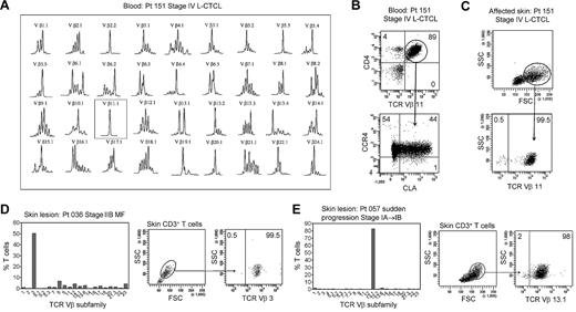 Figure 3. THS cells from the lesional skin of L-CTCL and advanced MF are clonal and malignant. (A) Spectratype analysis was used to identify clonal populations of T cells in the blood of patients with L-CTCL. The number of individual peaks within each Vβ subfamily is reflective of the T-cell receptor diversity within that subfamily. Patient 151 had a clonal T-cell population expressing TCR Vβ 11.1. (B) Flow cytometric studies confirmed the presence of an expanded clonal population of CD4+ T cells in the blood that expressed TCR Vβ 11.1. This population had high expression of CCR4 and variable CLA expression. (C) T cells isolated from the involved skin of this patient contained 2 clear T-cell populations. The THS cell population was composed entirely of clonal and malignant T cells. Similar findings were observed in 3 additional patients with L-CTCL. (D-E) High-scatter lesional skin T cells from patients with MF with identifiable T-cell clones were uniformly clonal and malignant. T cells were isolated from lesional skin and TCR diversity was analyzed with the use of flow cytometry. In a subset of patients, an identifiable clone was found. Selectively gating on the high-scatter population of lesional skin T cells showed that the THS cell population was uniformly composed of clonal malignant T cells. SSC indicates side scatter. In gated histograms, the % total cells in each quadrant are shown.