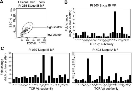 Figure 4. THS cells in early-stage MF are enriched for clonal or oligoclonal T-cell populations. (A) THS and low-scatter T cells were isolated from a panel of patients with stage IA-stage IB MF. (B) The preferential presence of T cells expressing particular TCR Vβ subfamilies was analyzed by comparing the fold change in the frequency of each TCR Vβ subfamily in the high- versus low-scatter population (percentage of TCR Vβ high-scatter/percentage of low-scatter). There was a trend toward oligoclonality or clonality in the high-scatter population. The 3 patients shown had identifiable T-cell clones on TCRγ PCR. SSC-H indicates side-scatter height; FSC-H, forward scatter-height.