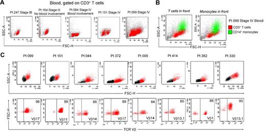 Figure 5. Clonal and malignant THS cells are present in the blood of patients with L-CTCL. (A) THS cells were present in the blood of patients with CTCL with known blood involvement but absent in patients without evidence of peripheral blood disease. Representative patients are shown; a THS cell population has been confirmed in 16 patients with L-CTCL. (B) Blood THS cells were obscured by monocytes in some patients. Staining for CD3 in addition to CD4 was required to show these cells. (C) THS cells were uniformly clonal and malignant in patients with L-CTCL and identifiable malignant T-cell clones. Shown are 8 patients with L-CTCL with identifiable T-cell clones. THS cell populations (red) were present in all patients. Selective gating on THS cells showed that most were clonal malignant T cells. SSC-A indicates side-scatter area; FSC-H, forward-scatter height.