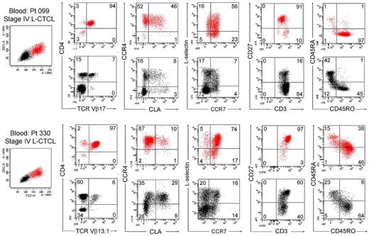 Figure 6. THS cells from the blood of patients with L-CTCL were clonal proliferative CD4+ CCR4+ memory T cells expressing central memory T-cell markers. The phenotype of high-scatter (red) and low-scatter (black) T cells of 2 patients with L-CTCL are shown. In both patients, THS cells virtually all clonal CD4+ cells expressing high levels of CCR4 and variable levels of CLA. Most THS cells coexpressed the TCM cell markers L-selectin and CCR7 and retained CD27 expression. Two representative patients are shown; similar results were found in 6 additional patients with L-CTCL. In gated histograms, the % total cells in each quadrant are shown.