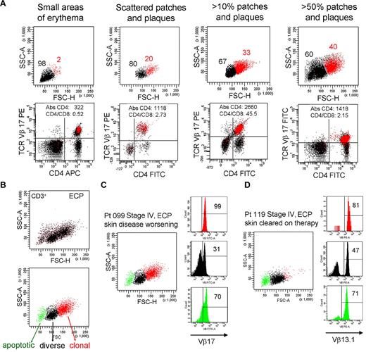 Figure 7. The presence of THS cells in blood correlates with skin disease severity. (A) Peripheral blood T cells were drawn from patient 099 (stage IV L-CTCL) over a 4-year period during which the extent of her skin disease fluctuated. The presence of THS cells (red) correlated with the severity of skin disease. At all time points, THS cells were clonal CD4+ T cells expressing the previously identified malignant TCR Vβ17 clonotype. The absolute CD4 T-cell count and CD4/CD8 ratio are also shown. (B-D) Successful clearing of skin lesions on ECP is associated with loss of the high-scatter malignant T-cell clone in patients with L-CTCL. (B) Three T-cell populations were typically evident in patients with CTCL with blood involvement on ECP. The lowest-scatter T-cell population, shown in green, had high levels of caspase 6 activation, consistent with apoptosis (data not shown). Two patients with stage IV L-CTCL with identifiable malignant clones and extensive skin involvement were studied. (C) Patient 099 had worsening of skin disease on ECP and had large numbers of clonal THS cells demonstrable in the blood. (D) Patient 119 experienced complete clearing of skin lesions on ECP, and study of her blood at the time of skin clearing showed very few high-scatter clonal T cells. Both patients also had some cells expressing the malignant Vβ subunit in the low-scatter T-cell population. SSC-A indicates side-scatter area; FSC-H, forward-scatter height; PE, phycoerythrin; APC, allophycocyanin; and FITC, fluorescein isothiocyanate. In gated histograms, the % total cells in each quadrant are shown.