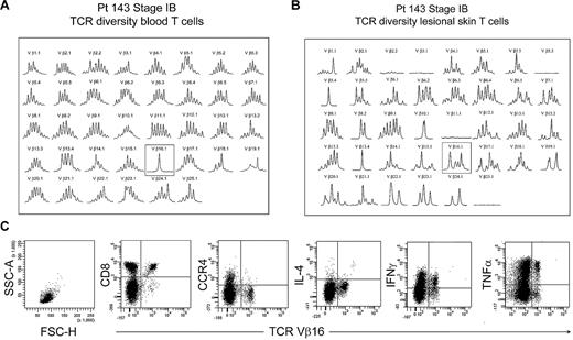 Figure 8. Benign clonally expanded T cells are found in the low-scatter T-cell population and can be discriminated from malignant T-cell clones. (A) Spectratype analysis of blood T cells showed a clonal T-cell population expressing TCR Vβ16.1 in a patient with long-standing stable stage IB MF and no other evidence of peripheral blood involvement. (B) Spectratype analysis of T cells isolated from skin lesions showed a diverse T-cell population expressing TCR Vβ16.1. (C) Further analysis of peripheral blood showed a lack of THS cells and showed that the expanded TCR Vβ16.1+ T-cell population was CD8+, lacked expression of CCR4, and produced effector cytokines, including interferon γ (IFNγ) and tumor necrosis factor-α (TNFα), suggesting that these cells represented a benign expanded CD8 clonal T-cell population. SSC-A indicates side-scatter area; FSC-H, forward-scatter height; and IL-4, interleukin-4.