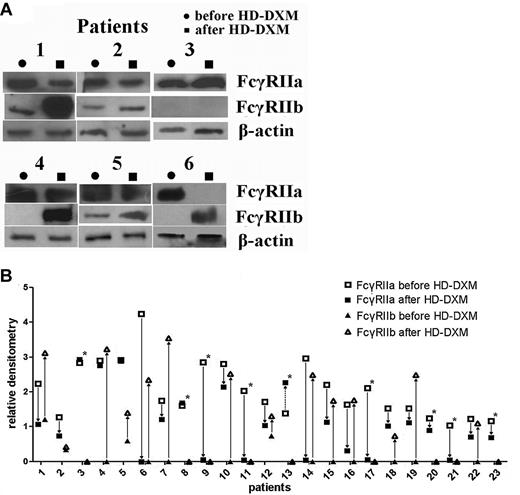 Figure 4. Modulation of FcγRIIa/IIb protein expression on monocytes before treatment and 2 weeks after initiation of HD-DXM therapy. (A) Representative Western blotting of monocyte lysates immunoprecipitated with anti–FcγRII cocktail and blotted with goat anti–human FcγRIIa, FcγRIIb, and β-actin are shown. (B) Changes of FcγRIIa and FcγRIIb protein expression on monocytes in patients after HD-DXM treatment. Fourteen of the 23 patients had increased FcγRIIb expression. *Patients who still showed no FcγRIIb expression after HD-DXM therapy.