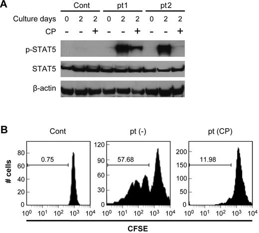 Figure 5. CP-690,550 inhibited the activation of the Jak3/STAT5 pathway present in patients ATL cells. (A) CP-690,550 inhibited the phosphorylation status of STAT5 in isolated T cells from patients with ATL. The T cells from a patient with ATL and those from a normal control were immediately isolated from the freshly separated PBMCs and lysed with cell lysis buffer; alternatively, the T cells were isolated from PBMCs cultured for 2 days with and without 50nM CP-690,550. Cell lysates were immunoblotted with anti–phospho-STAT5 monoclonal antibody and anti–STAT5 antibody. β-actin was used as an input control. (B) CFSE staining of CD3LowCD25+ lymphocytes was used to monitor cell division. ATL PBMCs were labeled with CFSE at day 0, and then cultured with (CP) or without (−) CP-690,550 for 6 days. FACS analysis of CD3LowCD25+CFSE triple-positive ATL cells were performed on day 6. Normal donor PBMCs (Cont) were used as a control. Because normal PBMCs proliferated under stimulation of anti-CD3/CD28 and ATL PBMCs spontaneously proliferated regardless of such stimulation, the nonstimulated normal and ATL PBMCs were chosen for analysis.