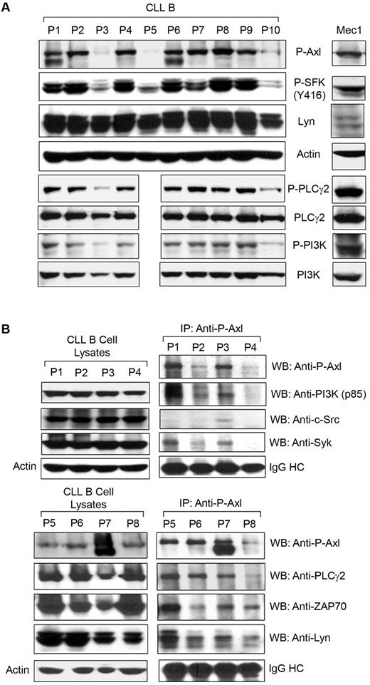 Figure 2. P-Axl is coexpressed with multiple constitutively phosphorylated non-RTKs and serving as a docking site in CLL B cells. (A) Expression of P-Axl is associated with coexpression of various phospho-nonreceptor kinases. CLL B-cell lysates from the same patient cohort as in Figure 1A were examined for the expression of various phosphorylated intracellular kinases shown by Western blot analysis. Actin was used as loading control. (B) P-Axl is physically associated with multiple nonreceptor kinases in CLL B cells. P-Axl was immunoprecipitated from purified CLL B-cell lysates from patients with CLL (n = 8) using a phospho-Axl–specific antibody. The precipitated immunocomplex was examined by Western blot analysis for the presence of various kinases. The IgG heavy chain (IgG HC) was shown for equal loading of the immunocomplex. Expression levels of these kinases in CLL B-cell lysates were also examined (left) for comparison. Actin was used as loading control for the cell lysates. Patients with CLL were assigned arbitrary numbers and are different from the cohort in Figure 1.