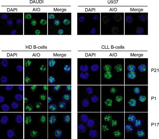 Figure 2. Localization of Aiolos protein in B cells from HDs and CLL patients. Samples were stained with anti-Aiolos antibody (green) and DAPI (blue) and analyzed by confocal microscopy. Similar results were obtained in 8 CLL patients. Daudi and U937 cells were used as positive and negative control for Aiolos expression, respectively.