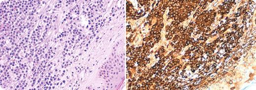 A 63-year-old woman had stage IIIb IgG κ multiple myeloma that contained a 13q deletion by fluorescence in situ hybridization. She was treated with vincristine, adriamycin, and dexamethasone, which achieved a partial response. Three months later, there was clinical and biological progression. Despite treatment with bortezomib and dexamethasone, a plasmacytoma developed in the right scapula. Further treatment included local radiotherapy followed by autologous peripheral blood stem cell transplantation (PBSCT). / Three months after transplantation, rose-colored nontender nodules appeared on the skin of the right arm. A skin biopsy showed a diffuse infiltrate of plasma cells in the dermis (shown, left) that were strongly immunoreactive for κ chain (shown, right). The patient died a few weeks later. / Although extramedullary relapses of myeloma are occasionally seen after PBSCT, skin involvement is a rare event.
