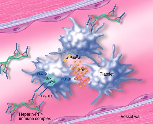 Role of Syk tyrosine kinase in the mechanism of platelet activation and thrombosis in heparin-induced thrombocytopenia (HIT). Platelet factor 4 (PF4) released from platelet α-granules binds with high affinity to heparin through a charge-charge interaction. The heparin-PF4 complex acts as an immunogen, and exposure to heparin after an initial sensitization will lead to the formation of immune complexes, in which the heparin-PF4 aggregates are coated with IgG. These circulating immune complexes activate blood cells expressing Fcγ receptors, including human platelets that express FcγRIIA. After binding to the immune complex, this receptor signals through Syk and activation of phospholipase Cγ2, leading to platelet shape change, aggregation and secretion of granule contents, including ADP. Platelet aggregates form thrombi, which lead to ischemic disease complications characteristic of HIT. (Professional illustration by Marie Dauenheimer.)