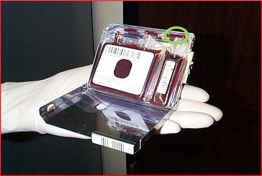 Figure 2. CB unit with attached segments for confirmatory HLA typing and other tests of unit quality. If the specimen used for confirmatory typing is obtained from an associated sample (eg, a test vial), there is a potential risk that this sample came from another unit and, therefore, the wrong unit will be shipped. Therefore, performing CT from an attached or contiguous segment (green circle) is the critical test of unit identity.