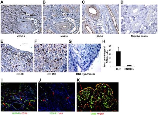 Figure 1. Hemophilic synovium expresses proangiogenic mediators and myeloid cells. Immunohistochemical analyses using DAB revealed positive staining for proangiogenic mediators VEGF-A (A), MMP-9 (B), and SDF-1 (C), in hemophilic synovium but not control synovium (D) (original magnification ×200). Immunohistochemical staining for CD68 (E) and CD11b (F) provided evidence for the presence of myeloid cell infiltration not observed in control synovium (G). Quantitative assessment of CD68+ cells in hemophilic and control synovium demonstrated an increased percentage of CD68+ cells in hemophilic synovium (HJD) compared with control (CNTRLs) (H). Immunofluorescent staining (red arrow) demonstrates CD11b+ cells coexpressing VEGF-R1 (I) in hemophilic synovium. Hemophilic synovium also contained VEGFR1 (red arrows) cells coexpressing the early HPC marker c-kit (J). These CD68+ cells expressed VEGF showing coexpression within the hemophilic synovium (K). Total number of sections stained for both experimental and control groups detailed in “HJD synovium expresses proangiogenic mediators and myeloid cells” (original magnification ×400).