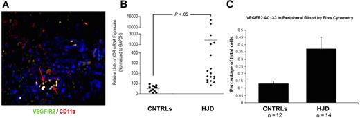 Figure 4. Endothelialization occurs in HJD synovium. (A) HJD synovium coexpressed VEGFR2/CD 11b (indicated by yellow staining with red arrows), late EPC markers. (B) VEGFR2 mRNA (labeled kdr, mouse equivalent of human VEGFR2) levels as quantified by quantitative PCR were increased in the peripheral blood of HJD subjects compared with control groups A and B (CNTRLs). (C) Significantly increased numbers of VEGFR2+/AC133+ early EPCs were also observed in the peripheral blood of HJD subjects compared with control groups A and B (CNTRLs). These data are expressed as a percentage of total peripheral blood mononuclear cells analyzed by flow cytometry.