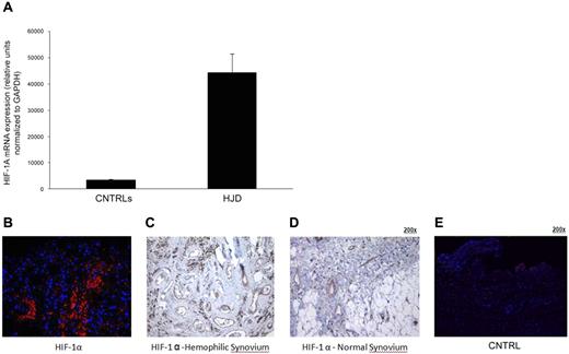 Figure 6. Sera from HJD subjects induce expression of HIF-1α in synovial cells. (A) Synovial cells were incubated with HJD serum and serum from control groups A and B for 10, 30, and 60 minutes, after which mRNA was extracted and subjected to quantitative PCR. (A) Significantly increased mRNA expression for HIF-1α was observed at 60 minutes in cells incubated with HJD serum compared with control serum (CNTRLs; P < .0001). No significant difference was observed at the 10- or 30-minute time points. Results represent data from 3 independent experiments. (B) Immunofluorescence of hemophilic synovium expressing HIF-1α. Immunofluorescence using a monoclononal antibody against HIF-1α demonstrated abundant expression of HIF-1α in hemophilic synovium in the endothelial cells and lining cells (B) but not in control synovium (E). Similarly, immunohistochemical staining using DAB confirmed HIF-1α positivity in similar regions in hemophilic synovium (C, original magnification ×40) and expression of HIF-1α only in endothelial cells in normal synovium (D, original magnification ×40). Results were replicated in 8 different hemophilic samples and 6 control samples and represent data from 1 set of samples.