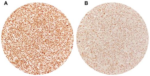 Figure 5. MLH1 expression inDLBCLs. Immunohistochemical analysis of MLH1 protein expression in paraffin sections from representative DLBCL primary biopsies. (A) A representative DLBCL sample harboring the MLH1 rs1799977 AA genotype and characterized by a strong nuclear positivity for MLH1. (B) A representative DLBCL sample harboring the MLH1 rs1799977 GG genotype and characterized by a weak nuclear positivity for MLH1. Tissue microarray, immunoperoxidase, hematoxylin counterstain. Images were taken using a Nikon Eclipse 80i microscope (Nikon) with a pan fluor 20×/0.13 objective and Nikon digital sight DS-Fi1 camera equipped with control unit-DS-L2 (Nikon). Images were assembled using Adobe Photoshop 6 (Adobe Systems).