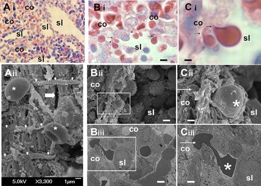 Figure 1. Fine structure of interendothelial slits in the sinus wall of the human splenic red pulp. (Ai) Reticular meshwork in the human spleen red pulp made of cords (co) and sinus lumens (sl) on a Giemsa-stained histologic section (original magnification ×200). (Aii) Typical scanning electron micrograph of the abluminal side of a sinus wall in the red pulp, with periodic helical basal fibers (white arrowheads), normal RBC (stars), and a narrow interendothelial slit (horizontal thick arrow). (B) Squeezing of RBCs crossing an interendothelial slit, from the cord (co) to the sinus lumen (sl) on a Giemsa-stained histologic section (original magnification ×1000): (i black arrows), scanning (ii, white square), or transmission (iii, white square) electron micrograph of a human spleen. (C) Same pictures at original magnification ×4000. On electron micrographs (ii-iii), one part of the RBC (star) has emerged in the sinus lumen, although the other is still in the process of leaving the cord (white arrow). This illustrates that the interendothelial slits are not long enough (typically < 3.5 μm) to accommodate the whole elongated RBCs as they squeeze through. Bi-iii: bar represents 4 μm; Ci-iii: bar represents 1 μm.