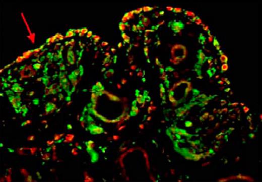 CD68+ cells coexpressing VEGF within the hemophilic synovium.