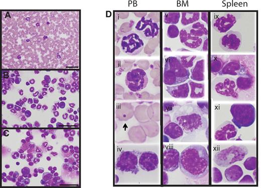 Figure 2. Hypoallelic mice have a mixed MDS/MPN disease. Peripheral blood smear (A), BM cytospin (B), and spleen cytospin (C) showing increased myeloid cells (animal #3339 used for images). Scale bars represent 50 μm (100×/1.30 NA oil objective magnification). (D) Dysplastic cells observed in peripheral blood, BM, and spleen of hypoallelic mice include hypersegmented granulocytes (i, ii, v, ix, and x), pseudo-Pelger-Huet-like atypical white cells (vi and xi), Howell-Jolly bodies (iii, indicated by arrow), dysplastic megakaryocytes (vii), and increased immature white cells (iv, vii, viii, and xii). Both NR4A1−/−NR4A3+/− (n = 2, at 9-11 months) and NR4A1+/−NR4A3−/− (n = 4, at 4-7 months) mice were used for this assay.