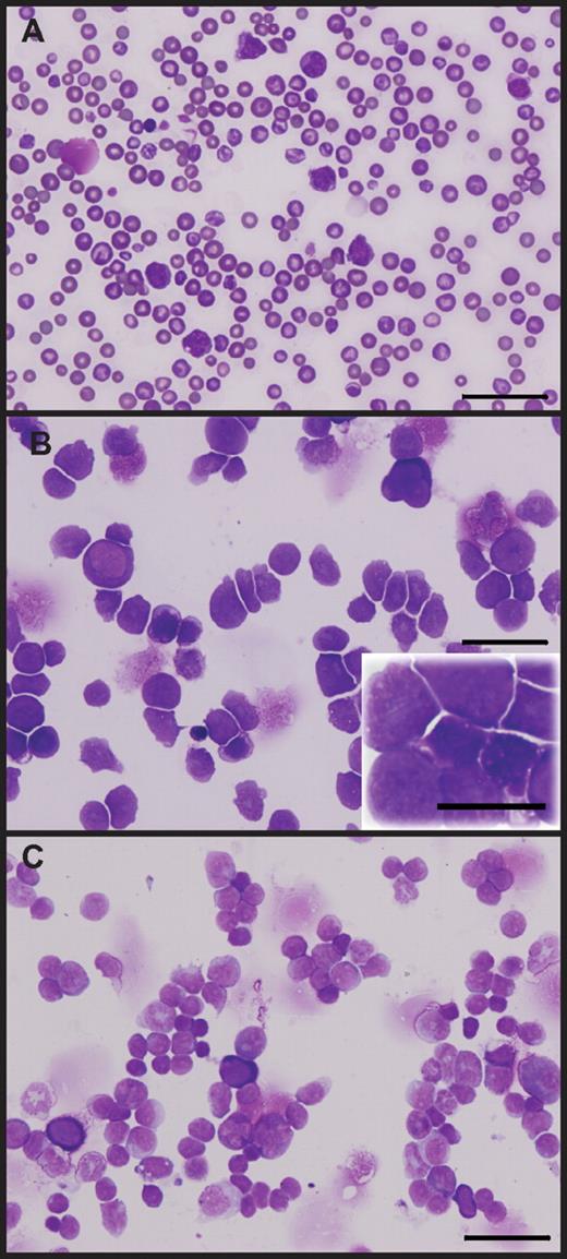 Figure 3. A rare subset of hypoallelic mice transform to AML. Peripheral blood smear (A), BM cytospin (B), and spleen cytospin (C) showing more than 20% immature/blast cells. Scale bars represent 50 μm (60×/1.25 NA oil objective magnification, inset 100×/1.30 NA oil objective magnification). Images shown are from a representative AML stage NR4A1+/−NR4A3−/− mouse; analysis was conducted when animal was moribund (at 9 months).