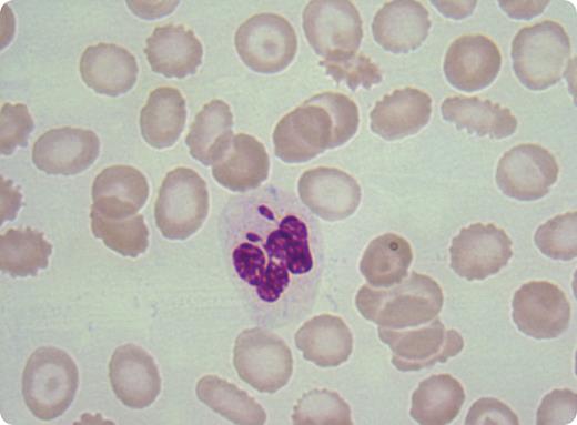 A 52-year-old woman presented with dyspnea, accompanied by anemia, thrombocytopenia, and leukocytosis. The peripheral blood showed blasts, promyelocytes, myelocytes, lymphocytes, and granulocytes, some of which had 2 drumstick-like appendages (shown). Bone marrow examination revealed myelodysplastic syndrome–myeloproliferative disorder (MDS-MPD) nonclassifiable. The presence of double drumsticks prompted a cytogenetic study that showed XXX. / The triple X syndrome, with a reported incidence of 1/1000 females, is associated with neurodevelopmental defects, but not with MDS-MPD or other hematologic disorders. The X inactivation center ensures that all but one X chromosome are randomly inactivated by epigenetic silencing. Once X inactivation has been established, the silent X chromosome is stably maintained in somatic cells and visible in blood smears of healthy women in up to 17% of neutrophils as a drumstick-shaped appendage. Two drumsticks in one cell was seen in this case of XXX, but it can be observed in other genetic disorders such as 48 XXXY. Finally, more than one drumstick can appear in acquired disorders such as MDS-MPD. / Retrospectively, the genotype of this woman was suspected by examining the blood smear, wherein 2 nuclear appendages depicted 2 inactivated X chromosomes.