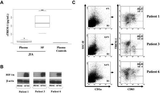 Figure 7. TREM-1 expression in vivo in hypoxic mDCs from JIA-SF. SF was collected from children affected by JIA, and SFMCs were purified as detailed in “SFMC isolation.” (A) sTREM-1 concentrations were quantified by ELISA in paired plasma and SF from 8 JIA patients and plasma from 5 age-matched control subjects. Individual samples were run in triplicate. Boxes represent the values falling between the 25th and 75th percentiles; whiskers, the highest and lowest values for each subgroup. Bold horizontal lines represent median values. P value by the Wilcoxon rank test is indicated: *P < .01 relative to plasma controls; **P < .001 relative to plasma from JIA patients. (B) HIF-1α expression was assessed by Western blot analysis on whole protein extracts from 3 pairs of fresh PBMCs and SFMCs purified from a subset of the JIA patients shown in panel A. Protein (100 μg) was resolved on 8% SDS-PAGE, and the blots were hybridized with anti-HIF-1α mAb. β-actin was evaluated as a loading control. (C) Flow cytometric analysis of TREM-1 expression in SF-mDCs. SFMCs from the 3 JIA patients shown in panel B were stained with anti-CD1a-allophycocyanin, CD83-FITC, and-TREM-1-PE Abs and analyzed on a FACScan. Cells were electronically gated according to their light scatter properties to exclude cell debris. The gated population was analyzed for CD1a positivity (left panels, region R1), and CD1a+ cells were then examined for CD83 and TREM-1 expression (right panels). Nonspecific staining was corrected using isotype-matched Abs. Numbers represent the percentage of single- and double-positive cells within the CD1a-gated population and are indicated for each patient: TREM-1/CD83 double-positive cells are contained in the top right quadrant, whereas CD83 and TREM-1 single-positive cells are contained in the bottom right and top left quadrants, respectively. Cells stained with control Abs are in the bottom left quadrant. The percentage of TREM-1+ cells relative to the total number of CD83+ cells (representing TREM-1-expressing mDCs) was 88%, 60%, and 80% in patients 1, 3, and 6, respectively, whereas the percentage of TREM-1+ cells relative to the total number of CD83− cells (representing TREM-1-expressing iDCs) was 74%, 80%, and 80% in patients 1, 3, and 6, respectively.
