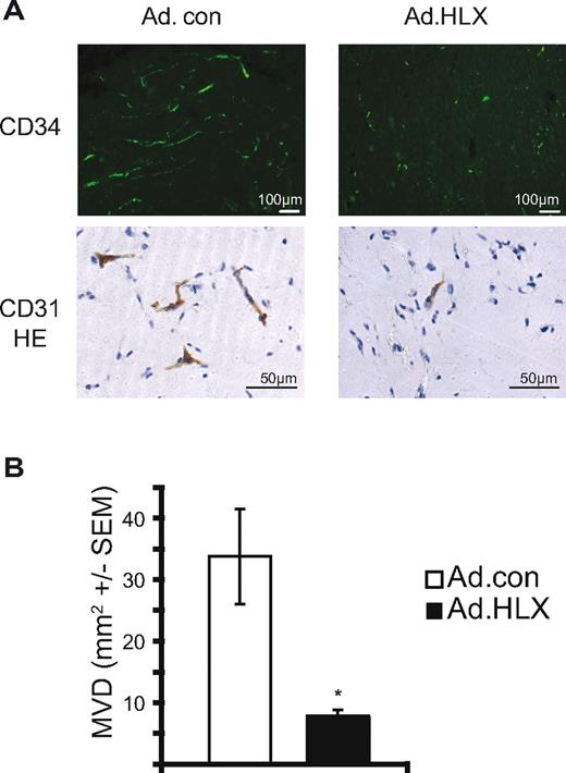 Figure 6. HLX reduces vessel formation in an endothelial spheroid xenografting assay in vivo. HUVEC were infected with HLX-encoding adenoviruses and control viruses with an MOI of 20. The infected cells were used to generate endothelial cell spheroids consisting of approximately 100 cells/spheroid. Spheroids were suspended in a Matrigel/fibrinogen mixture containing 500 ng/mL VEGF and bFGF. After addition of thrombin the spheroid suspension was injected subcutaneously into SCID mice (2 plugs/mouse, 8 mice/experimental group). Plugs were harvested after 14 days, fixed, and analyzed by immunohistochemistry using CD31 or CD34 or antibodies. (A) Representative images of sections of plugs containing HUVECs infected with Ad.HLX or Ad.con and stained with anti-human CD34 antibodies or anti-human CD31 antibodies plus hematoxylin. (B) Evaluation of vessel formation was performed by measuring the vessel areas stained for CD34 on 16 images of 8 sections. The MVD per mm2 ± SEM is depicted for plugs containing vessels with Ad.HLX (■) and Ad.con (□) infected HUVEC. *P < .05, t test.