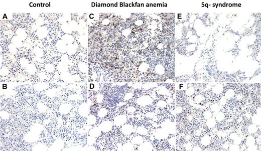 Figure 6. p53 staining of bone marrow biopsies. Immunohistochemistry for p53 on histologic sections of bone marrow biopsies from patients with (A) aplastic anemia, (B) autoimmune hemolytic anemia, (C-D) DBA, and (E-F) MDS with del(5q). (A-F) Original magnification ×400. The samples were analyzed using an Olympus BX41 microscope with the objective lens of 40×/0.75 Olympus UPlanFL (Olympus). The pictures were taken using Olympus QColor5 and analyzed with acquisition software QCapture Pro v6.0 (QImaging) and Adobe Photoshop 6.0.