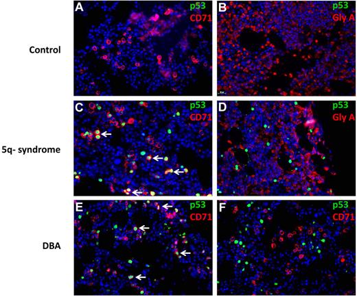 Figure 7. Colocalization of p53 and CD71 in 5q− and DBA patient samples. Histologic sections of bone marrow biopsies from patients were analyzed by double immunofluorescence for p53 and cell surface markers (CD71 or GlyA). The antibodies used are indicated in each panel. Bone marrow biopsies are shown from patients with hemolytic anemia (A-B), del(5q) MDS (C-D), and DBA (E-F). (A-F) Original magnification ×400. The stained slides were scanned using the TissueFAXS Plus automated microscopic workstation (Tissuegnostics) with a Zeiss Axiolmager Z1 using a 40× Zeiss objective using a high sensitivity digital monochrome camera for fluorescence microscopy (TissueGnostics), and captured using TissueFAXS 1.3 software (TissueGnostics). Final images were transferred into Adobe Photoshop 6.0 where TIF files were created. Scale bar represents 25 μm.