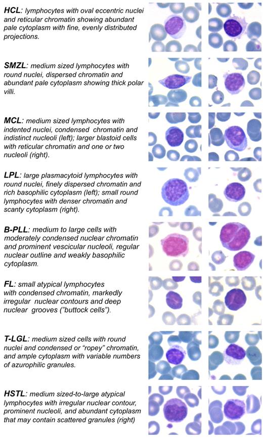 Figure 2. Morphologic clues of SL neoplastic cells in the PB. May-Grunwald-Giemsa stain: original magnification ×630. Images were captured by a Leica DM 3000 optical microscope, Leica DFC 320 digital camera, and Leica IM50 software.