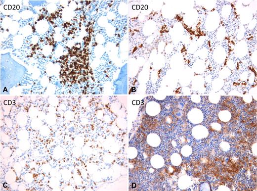 Figure 3. BM intrasinusoidal infiltration pattern in different SL entities. (A) SMZL: mixed nodular and intrasinusoidal infiltration. (B) SDRPSBCL: neoplastic cells are exclusively lodged inside the dilated sinusoids. (C) T-LGL: subtle intrasinusoidal and interstitial infiltration. (D) HSTL: highly atypical large neoplastic cells engulf the BM sinusoids. (A-B) Anti-CD20 immunostaining using the streptavidin-biotin-peroxidase complex and 3–3′-diaminobenzidine (brown signal). (C-D) Anti-CD3 immunostaining using the streptavidin-biotin-peroxidase complex and 3–3′-diaminobenzidine (brown signal). (A-D) Original magnification ×200. Images were captured by a Leica DM 3000 optical microscope, Leica DFC 320 digital camera, and Leica IM50 software.