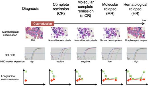 Figure 2. Terminology in MRD measurements. Definitions are based on the presence of blasts on light microscopy examination and disappearance of RT-PCR positivity in a sample with an acceptable sensitivity. RT-PCR panels represent raw data from MRD measurements of a patient using 2 control genes (red and blue curves) and one MRD marker (green curve). Longitudinal measurements represent MRD reporting as recommended by European Leukemia Network4 showing the MRD level (green crosses and lines) as well as the sample day-to-day sensitivity (red diamonds and lines).