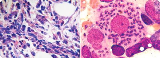 A 49-year-old man, with HIV positivity for 10 years, was hospitalized with fatigue, dyspnea, fever, and weight loss. The HIV infection was controlled despite a low CD4 count (113/mm3). Gastrointestinal leishmaniasis had been successfully treated with liposomal amphotericin B. Three months earlier, he had moderate pancytopenia with no serological or molecular evidence for leishmaniasis in peripheral blood. On admission, he had petechiae, purpura, and splenomegaly. / The white blood cell count was 1.0 × 103/mL, hemoglobin 6.6 g/dL, and platelets 6 × 106/mL. The bone marrow was dry. The core biopsy showed numerous lymphohistiocytic aggregates with intracellular and extracellular protozoa (left) and histiocytes with heavy parasitization by Leishmania amastigotes (right), aflagellate, round forms 2 to 4 mm in diameter (Leishman-Donovan bodies). The pancytopenia of the patient was related to the massive Leishmania donovani invasion of the bone marrow. Despite prompt treatment with liposomal amphotericin B, he died of severe bleeding. / HIV infection increases the risk of developing visceral leishmaniasis in areas where the organism is endemic. Patients on highly active antiviral therapy with an insufficient CD4 cell count despite undetectable HIV viral load are still at major risk of a first episode and of relapse of leishmaniasis.