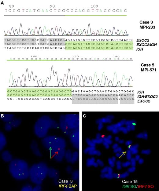 Figure 1. Cloning of the t(6;14)(p25;q32) translocation. (A) Chromatograms and sequences of the different chromosomal junctions of the IGHSμ/EXOC2 translocations in cases 3 and 5. The sequence of IGHSμ is shown according to GenBank accession no. NG_001019.3 and of EXOC2 according to GenBank accession no. NT_007592.15. The der(6) genomic breakpoints were located downstream of exon 22 (case 3) and exon 23 (case 5) of EXOC2 gene at 482 370 and 464 205 bp from 6pter (UCSC, NCBI Build 36.1/hg18). (B) FISH analysis shows IRF4 breaks in case 3. (C) FISH image on metaphase shows an IGK/IRF4 fusion in case 15.