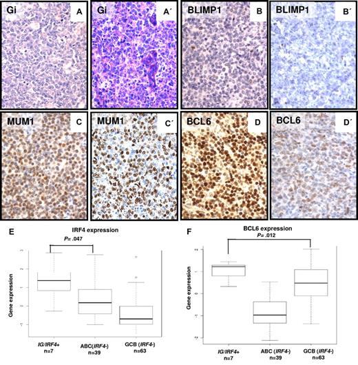 Figure 2. Morphologic and immunohistochemical features of IG/IRF4-positive cases. (A-D) Morphology and immunophenotype of 2 IG/IRF4-positive cases (A-D, case 14; A′-D′, case 20; original magnification ×400): DLBCL component with GC immunophenotype, strong nuclear staining for MUM1, and negativity for BLIMP1. The follicular component of both cases showed an identical immunophenotype (data not shown). Gi indicates Giemsa staining. (E) Differential expression levels of IRF4 (probe set U133A 216986_s_at) between IG/IRF4-positive cases and the other DLBCL subtypes, specifically with the ABC subtype (P = .047). (F) Comparison of the expression levels of BCL6 (2 probes encoding BCL6, 203140_at and 215990_s_at, summarized to BCL6 index) between IG/IRF4-positive cases and the other DLBCL subtypes. Specifically, IG/IRF4-positive cases presented higher expression of BCL6 than the GCB-DLBCLs (P = .012).