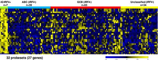 Figure 3. Gene expression profiling-based classifier of IG/IRF4-positive cases. This figure represents a heatmap of an IG/IRF4-positive classifier consisting of 32 probe sets (27 genes). This classifier distinguishes IG/IRF4-positive cases from the rest of DLBCL subtypes.